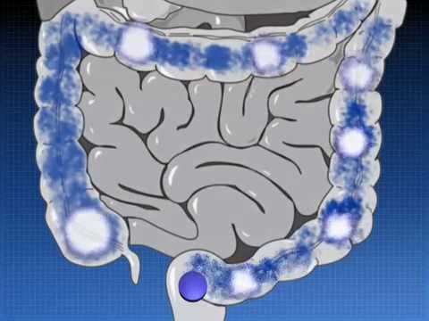 Видео о препарате Салофальк суппозитории (Salofalk) 500мг №30