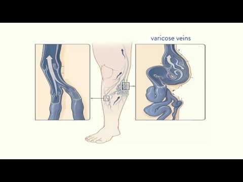 Видео о препарате Аэсцин